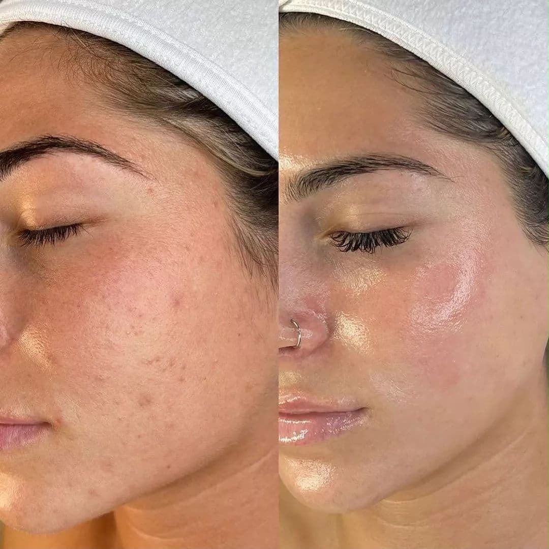 Resultado de tratamiento facial NIKÁ