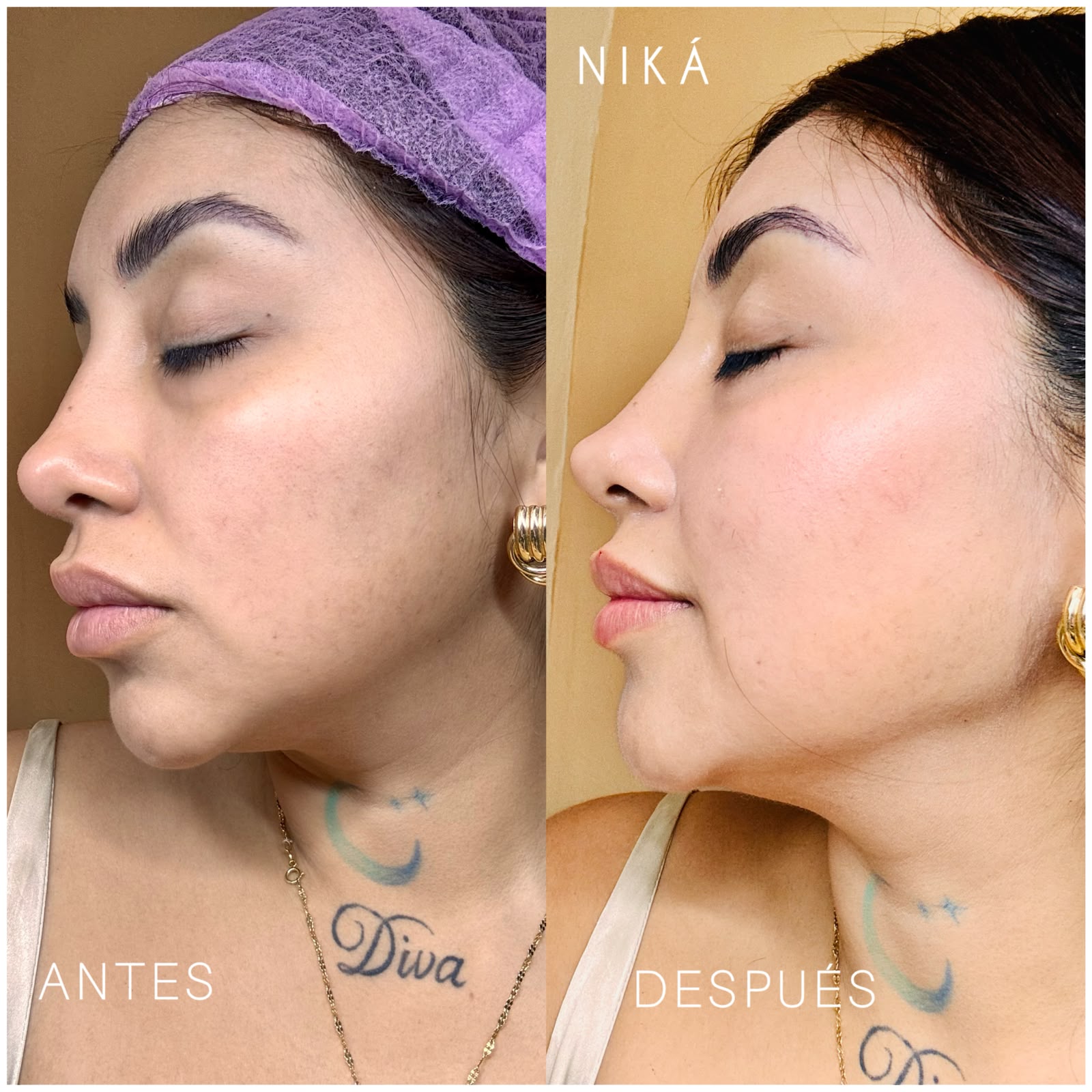 Antes y después de tratamiento NIKÁ