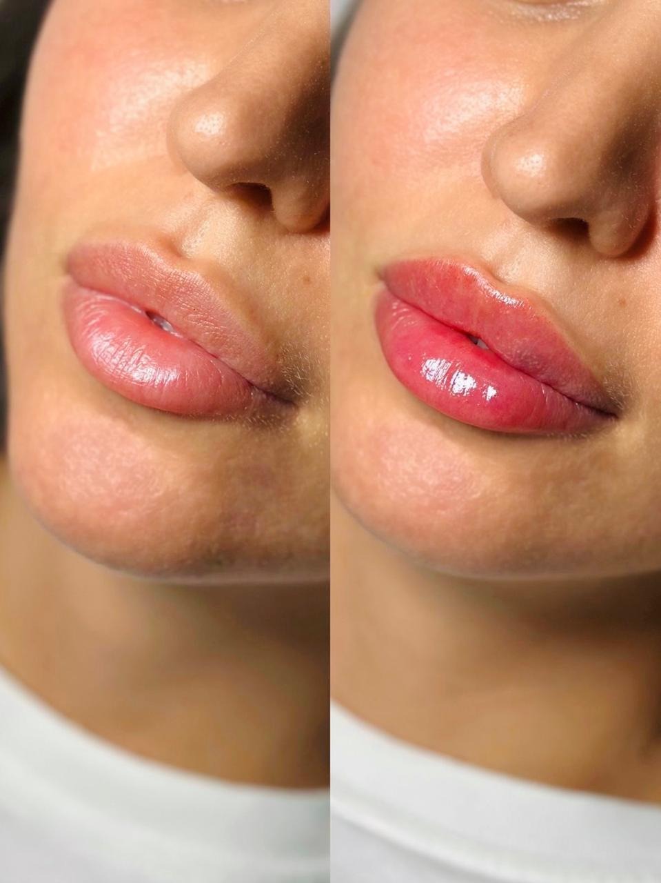 Antes y después de aumento de labios NIKÁ
