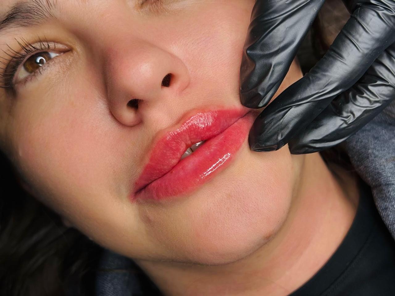 Resultado de aumento de labios NIKÁ